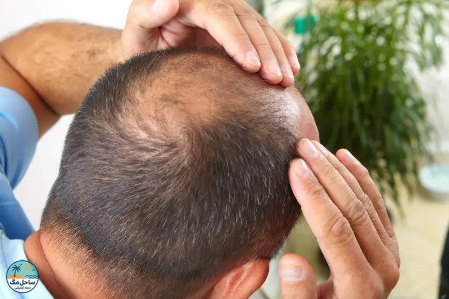 عوارض کاشت مو؛ 10 مشکل رایج و راهکارهای پیشگیری